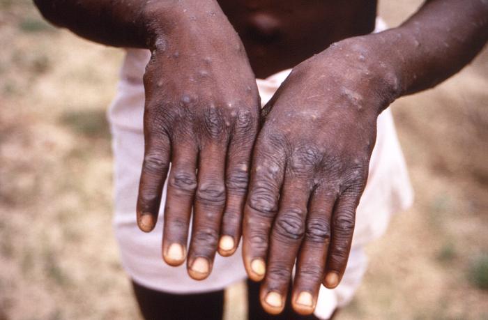 Monkeypox cases hit 241, Lassa fever now 909