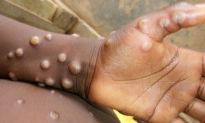 UPDATE: Monkeypox Claims Four Lives as NCDC Confirms 157 Cases